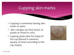 Skin Color Changes During Cupping Therapy Explanations And