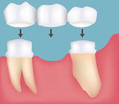 dental bridges upper st clair tooth