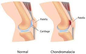 sharp knee pain from squatting 5