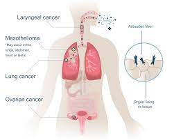 Abnormal cells grow and can form tumors. Asbestos Cancer Mesothelioma Lung Cancer More