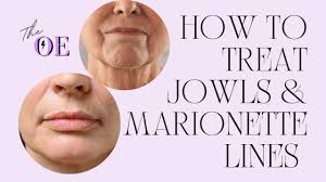 how to treat jowls marionette lines