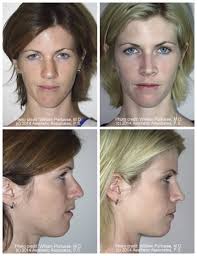 Maybe you would like to learn more about one of these? Wide Nasal Bones Before And After Photo Gallery Nose Surgery Photos