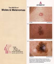 Malignant melanoma may differ from these melanoma images. Https Zdpf De Wp Content Uploads 2018 05 Melanoma Screening Pdf