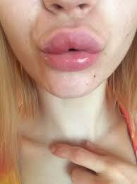 my lip after juvederm injections