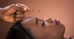 l acupuncture contre le mal de tête