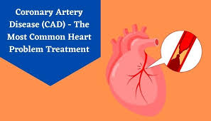 coronary artery disease cad the