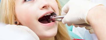 Also, in more severe cases, the gauze may be placed for up to an hour. Wisdom Teeth Aftercare What You Need To Know Australia Dental Clontarf