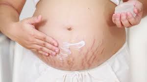 how to reduce stretch marks naturally