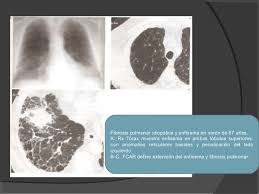 The cause of this fibrosis is not known (idiopathic). Patologia Instersticial Pulmonar Fibrosis Pulmonar Uveitis Avascular