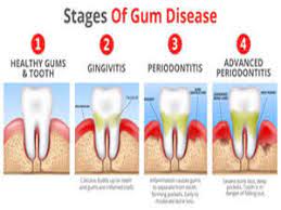how to relieve gum pain 123 dental