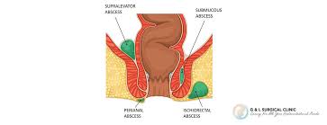 what is a peri abscess