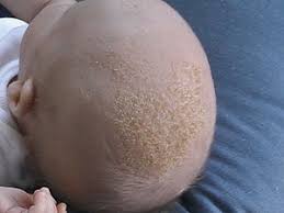 It is not known exactly why this falling out and replacement of hair takes place, it is likely to do with the changing hormone levels in the first few months. Cradle Cap Wikipedia