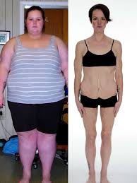 Cellulite & Skinny Fat, Weight Loss Before & After - Woman