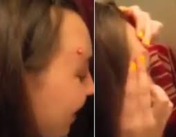 — subscribe us please biggest pimple biggest … biggest zit cyst pop ever!! Graphic Content Doctor Pops The Biggest Cyst He S Ever Seen On Man S Jaw Weird News Express Co Uk