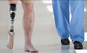 Workers Comp Social Security Disability For Loss Of Limb