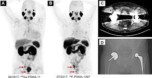 Image result for Ga-PSMA-11 prostate