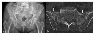 Image result for icd 10 code for left pubic ramus fracture