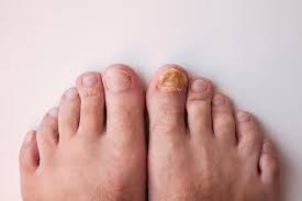 how does toenail fungus occur