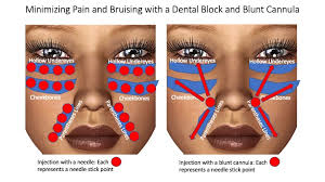 injecting fillers with a dental block
