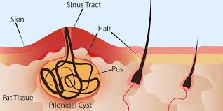 ayurvedic treatment for pilonidal sinus