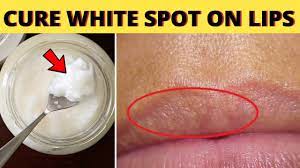 white ps on lips types causes