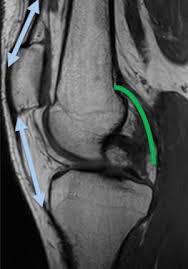 Magnetic resonance imaging (mri) interpretation of the knee is often a daunting challenge to the student or physician in training. Imaging Of Tumors And Tumor Like Lesions Of The Knee Sciencedirect