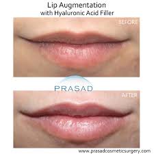 how to get natural looking lip fillers