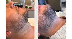 laser hair removal for men seattle