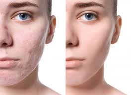 how can i get rid of acne scars lake