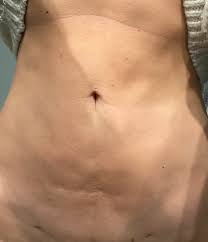 remove scar tissue from liposuction