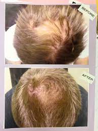 All other hairs are thus programmed to accelerate the birth of new, healthy hair follicles. Laser Hair Growth Treatment Call For Free Consultation Las Vegas Reno