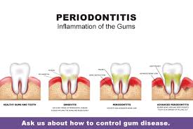 periodontal treatment deep cleaning