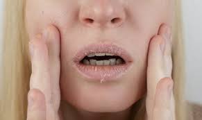 home remes to treat your dry lips