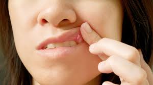 what to eat with canker sores the best