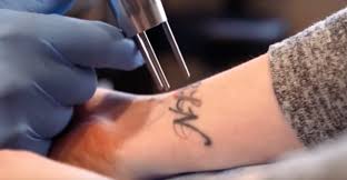 Who can operate a laser and remove tattoos? Here's how to find that out and  more - Jails to Jobs