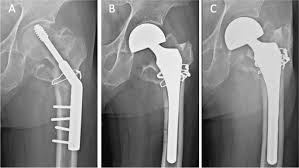 primary stem in hip arthroplasty