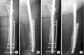 antegrade femur nail