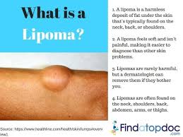 lipoma symptoms causes treatment