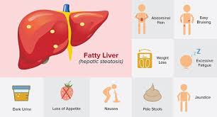 fatty liver disease hepatic steatosis