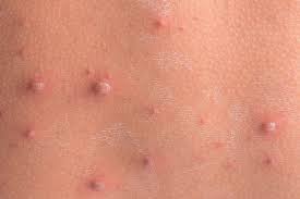 People always look for the rash, but her rash didn't develop. Rashes In Children Learning Article Pharmaceutical Journal