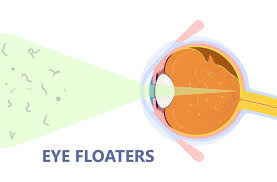 are floaters after cataract surgery
