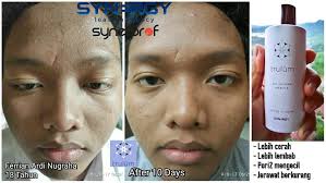 Trulum skin care (jujur tanpa rekayasa). Jual Trulum Plus Di Mayong Jepara Penghilang Flek Hitam Dan Jerawat Di Wajah