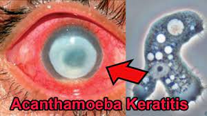 THIS BUG WILL EAT YOUR EYES: Acanthamoeba Keratitis - Endmyopia®
