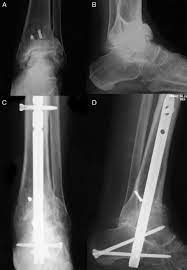 arthroscopic tibiotalocalcaneal