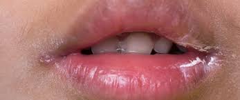 اسباب الجفاف حول الفم والاسنان