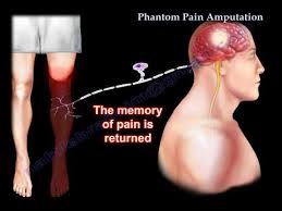 how to get rid of phantom pain limbionics