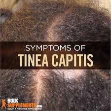 tinea capitis ringworm of the scalp