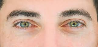 what causes dry eye how is it treated