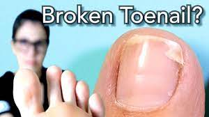 how you fix a broken toenail watch me