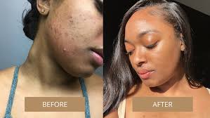 s if you ve been battling acne